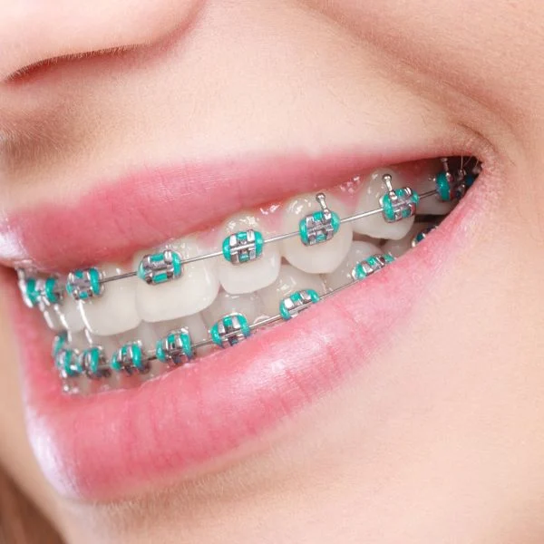 Braces Treatment in Bavdhan | Clear Aligners in Bavdhan