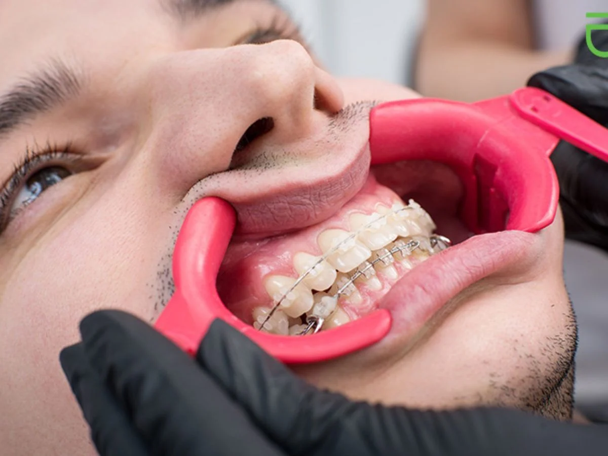 Braces Treatment in Pirangut | Clear Aligners in Pirangut