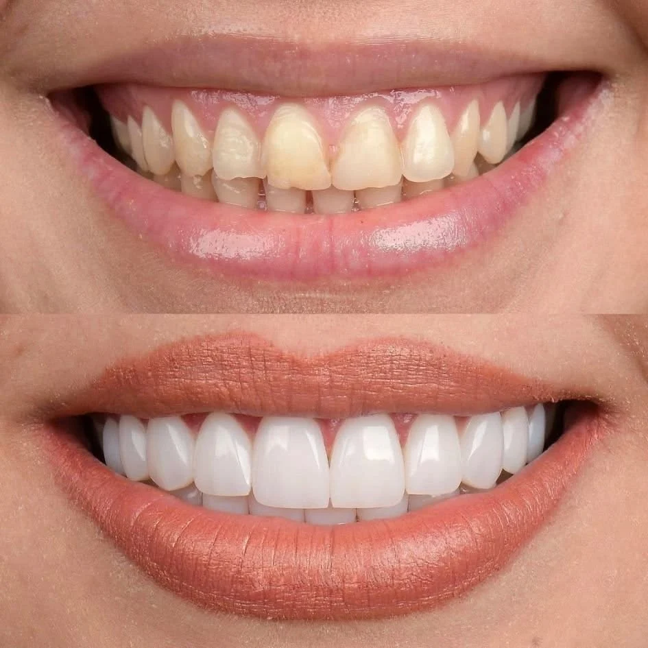 Cosmetic Dentist in Bavdhan | Smile Makeover
