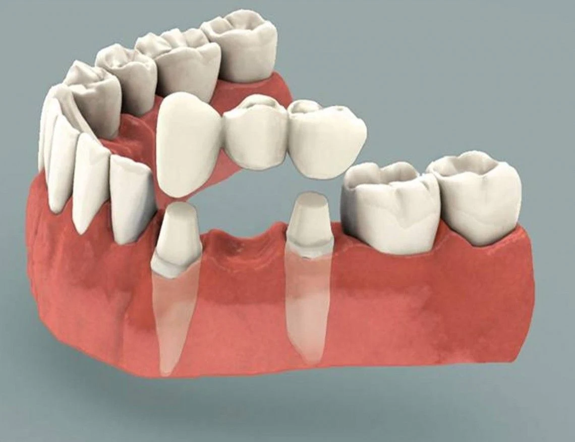 Dental Crown Treatment in Bavdhan | Tooth Restoration
