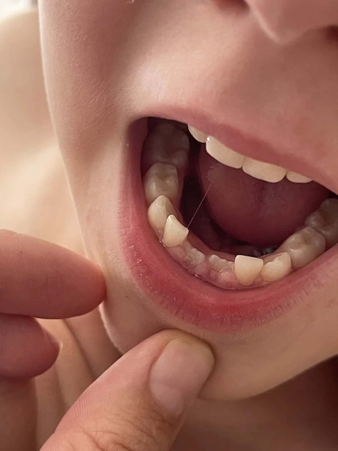 Dental Crown Treatment in Pirangut | Tooth Restoration
