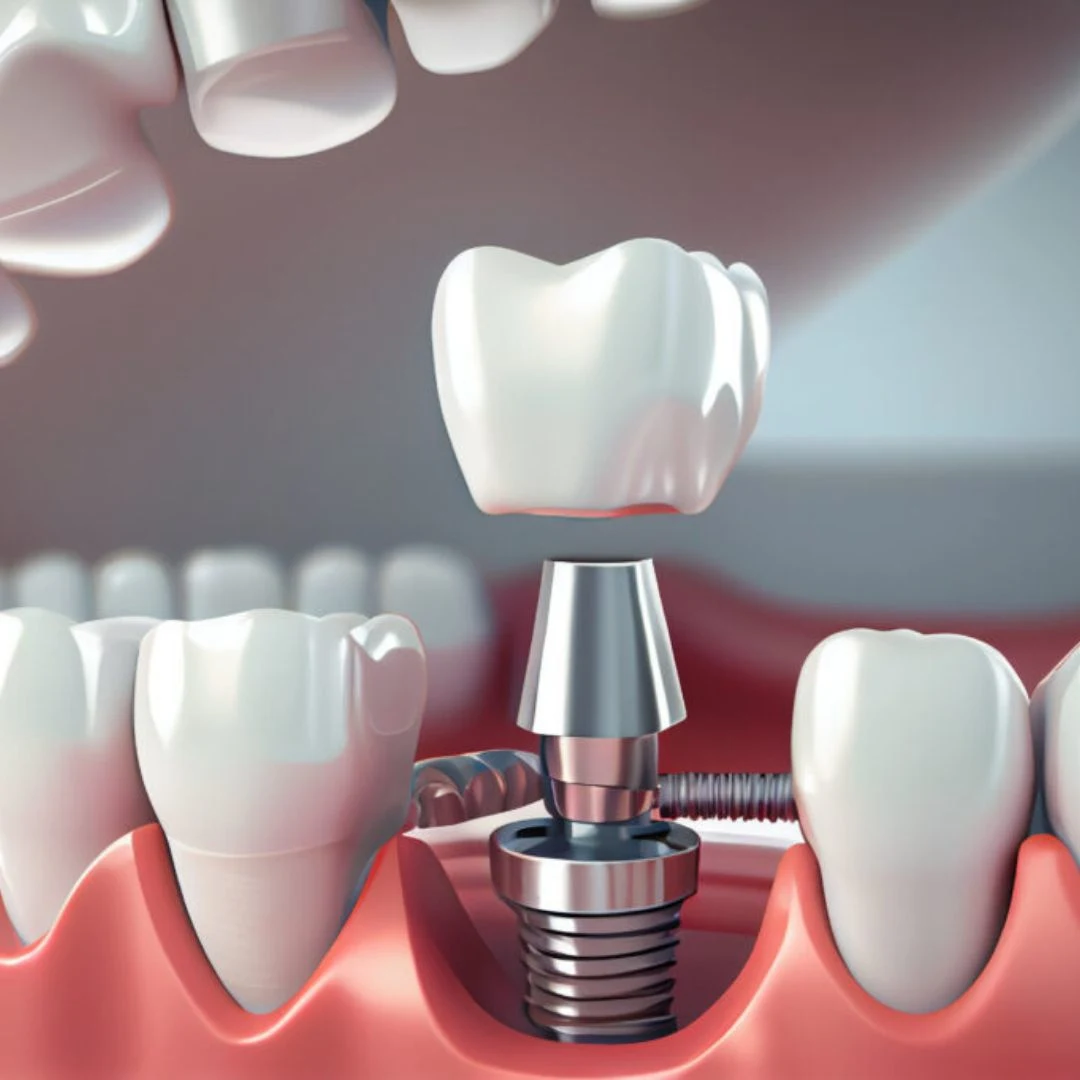 Dental Implants in Bavdhan | Full Mouth Dental Implants in Bavdhan