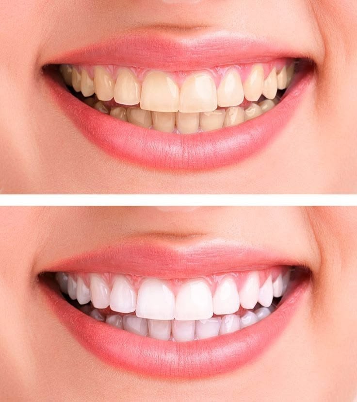 Teeth Cleaning in Bavdhan | Dental Cleaning