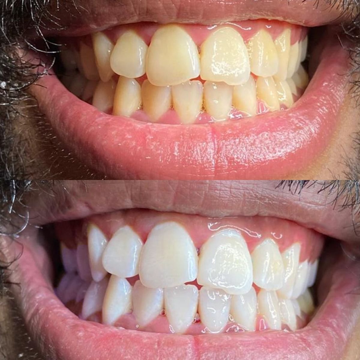 Teeth Whitening in Pirangut | Professional Teeth Whitening